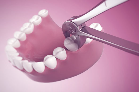 tooth extractions Adelaide tooth extractions Adelaide