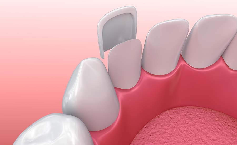 Dental Veneers in Adelaide