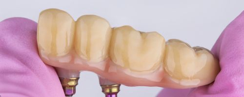 Dental Bridges Adelaide