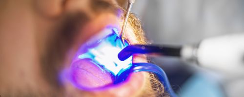 Dental Fillings Adelaide 