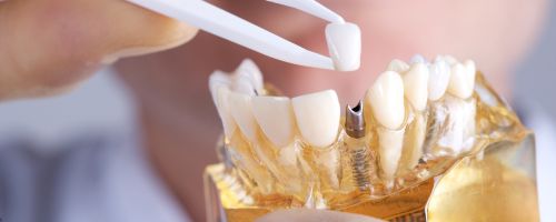 Dental Implants Adelaide