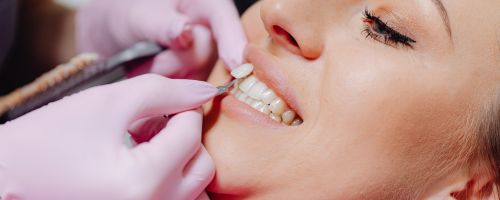 Dental Veneers Adelaide
