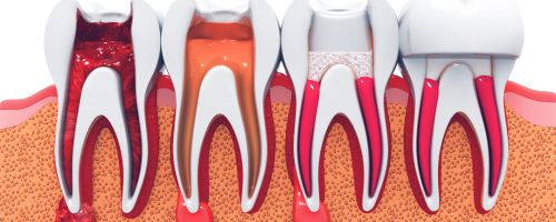 Root Canal Treatment Adelaide