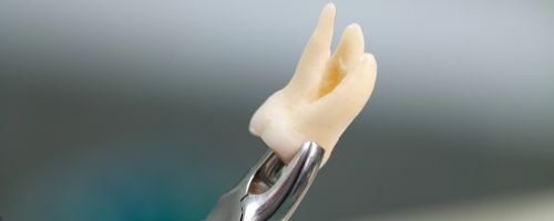 Tooth Extractions Adelaide